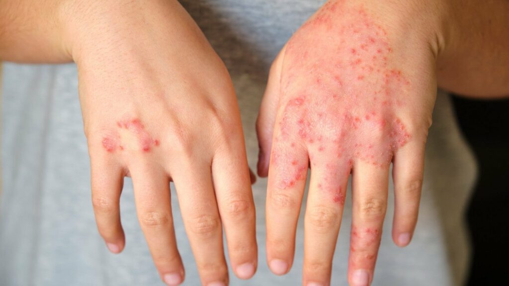 EC grants authorisation to LEO Pharma’s Anzupgo cream