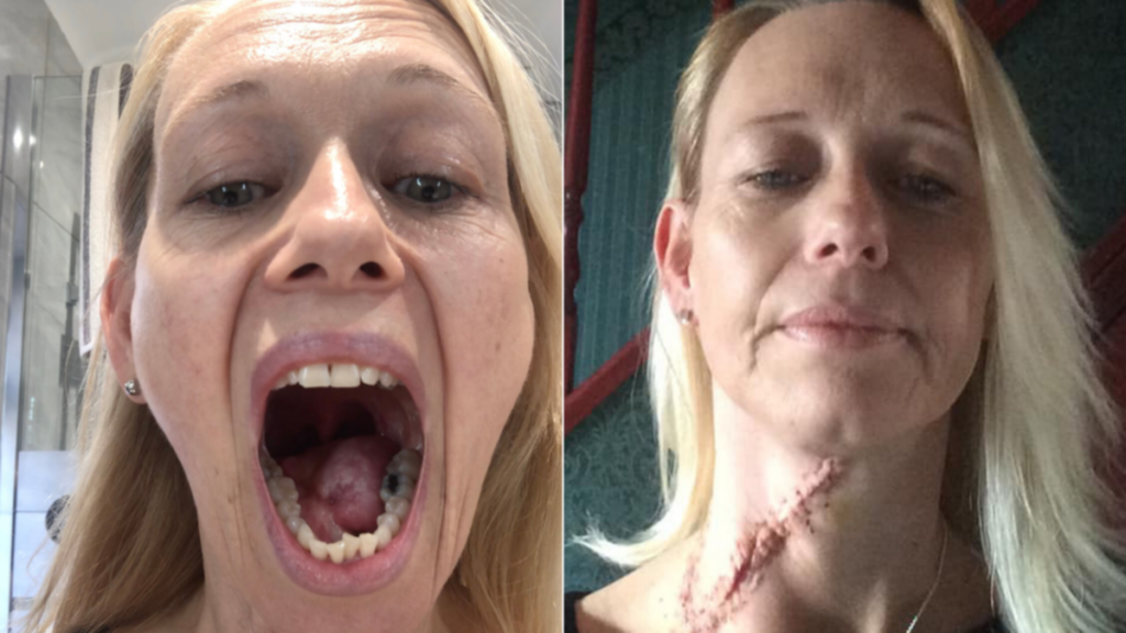 British woman’s tongue and neck removed after tiny ulcer turns out to be deadly cancer