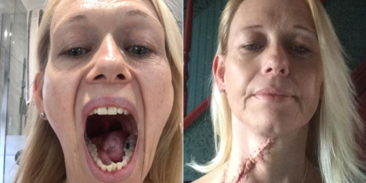 British woman's tongue and neck removed after tiny ulcer turns out to be deadly cancer