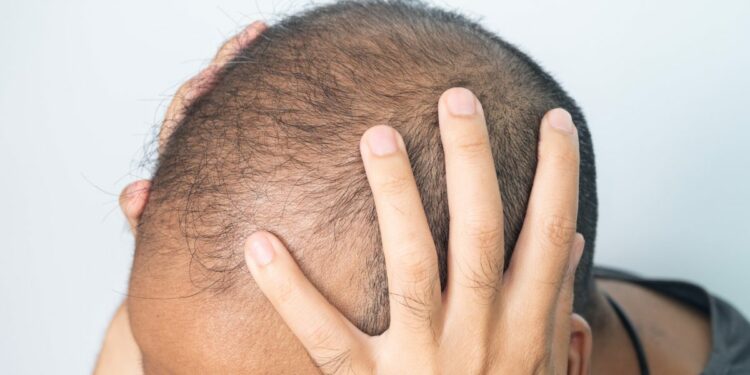 Hair loss drug probed in Europe over link to suicidal thoughts