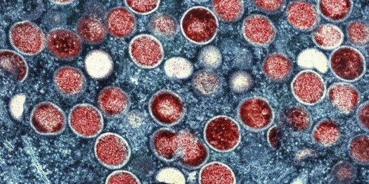 Sweden reports first case of more severe mpox strain